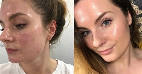 How To Repair Broken Capillaries On Face