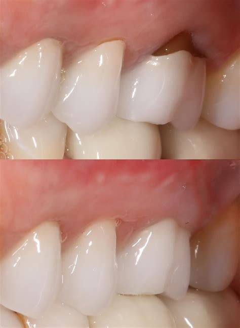 How To Repair Gum Recession